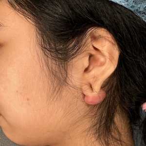 After ear keloid removal, close-up healed result - Plastic Surgery of New York