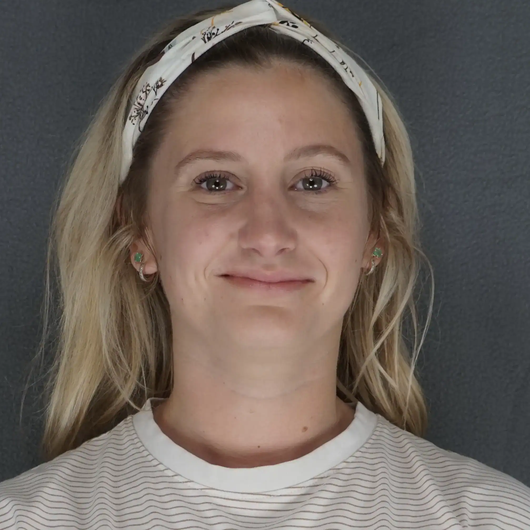 Oblique after view of rhinoplasty patient showing nasal dorsum bump removal and refined tip by Dr. Elkowitz, Plastic Surgery of New York – front view post op poster image