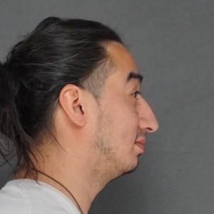 Middle-aged man with dorsal hump rhinoplasty preoperative side view plastic Surgery of New York New York City preop