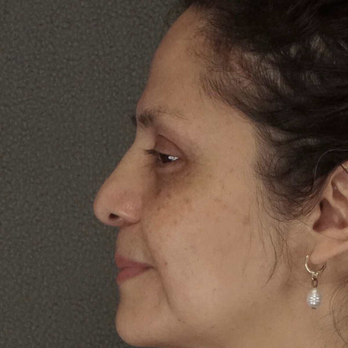 Middle-aged woman brow lift upper lower eyelid blepharoplasty after zoom-in side view - natural results Dr. Elkowitz Great Neck NY