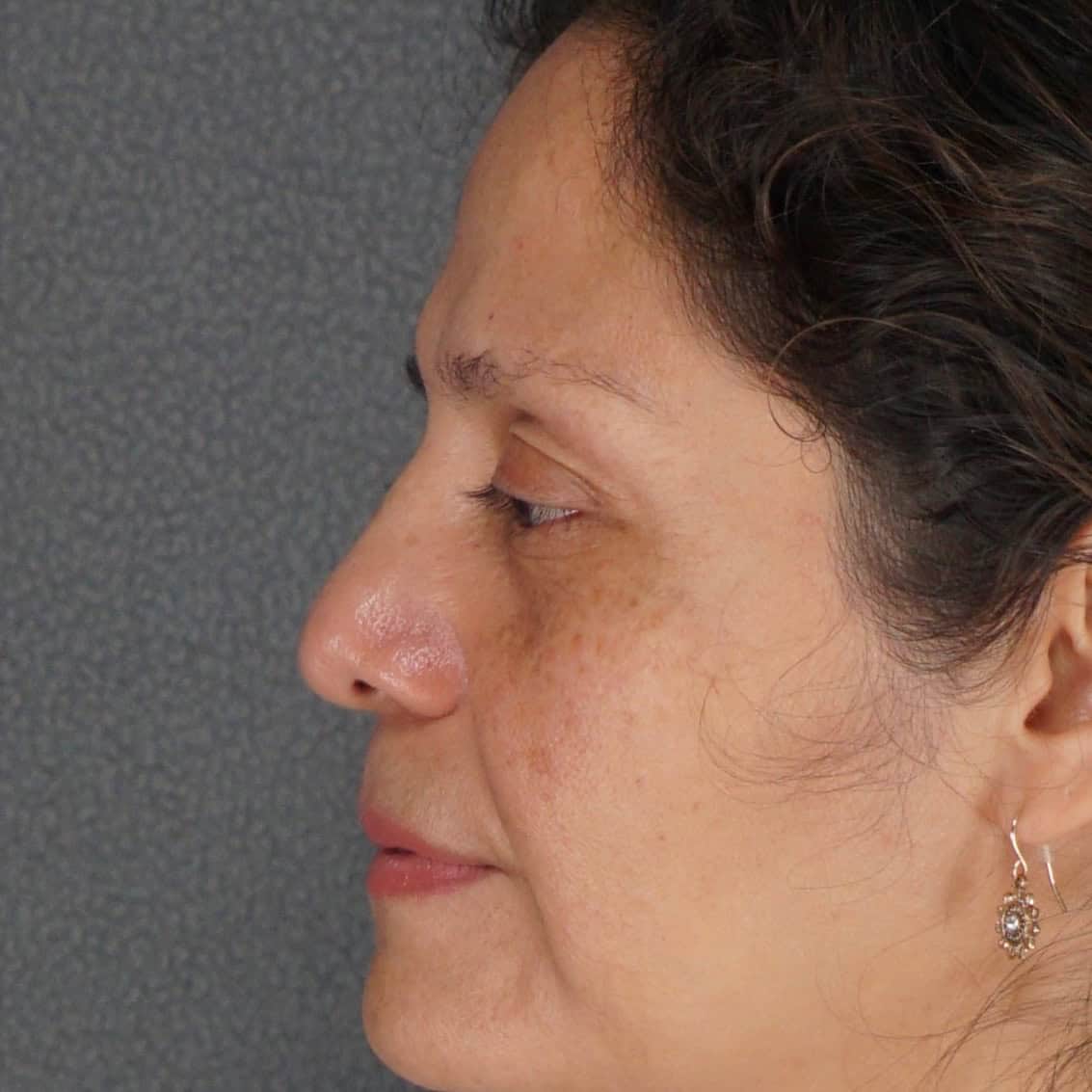 Middle-aged woman brow lift upper lower eyelid blepharoplasty before zoom-in side view - Dr. Elkowitz Great Neck NY