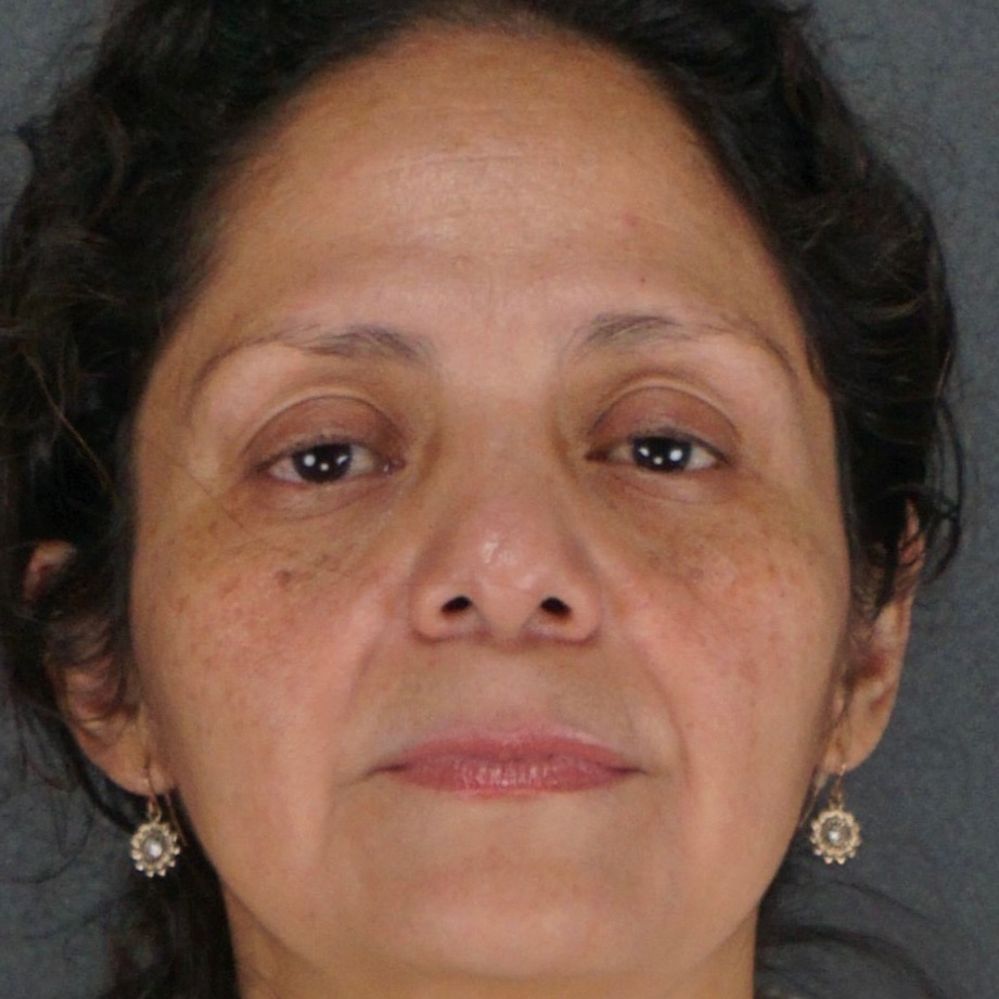 Middle-aged woman brow lift upper lower eyelid blepharoplasty before zoom-in front view - Dr. Elkowitz Great Neck NY