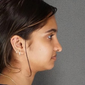 young woman rhinoplasty dorsal hump beautiful rhinoplasty new york city dr elkowitz post op lateral