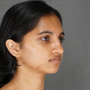 young woman rhinoplasty dorsal hump beautiful rhinoplasty new york city dr elkowitz pre op oblique