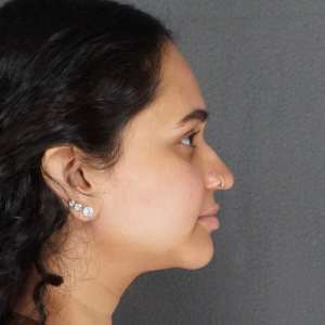 young woman rhinoplasty pre operative significant dorsal hump and drooping tip side n817