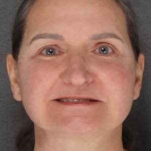 Before and after results – Plastic Surgery of New York