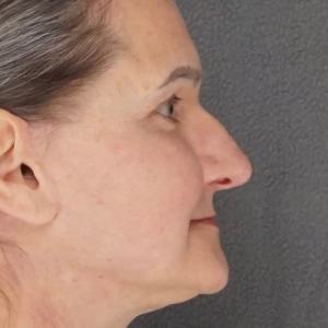 Before and after results – Plastic Surgery of New York