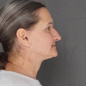 Before and after results – Plastic Surgery of New York