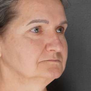 Before and after results – Plastic Surgery of New York