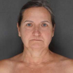 Before and after results – Plastic Surgery of New York