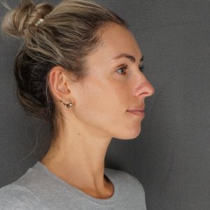 Before and after results – Plastic Surgery of New York