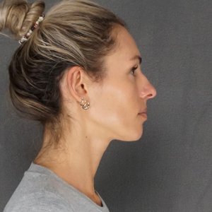 Before and after results – Plastic Surgery of New York