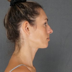 Before and after results – Plastic Surgery of New York